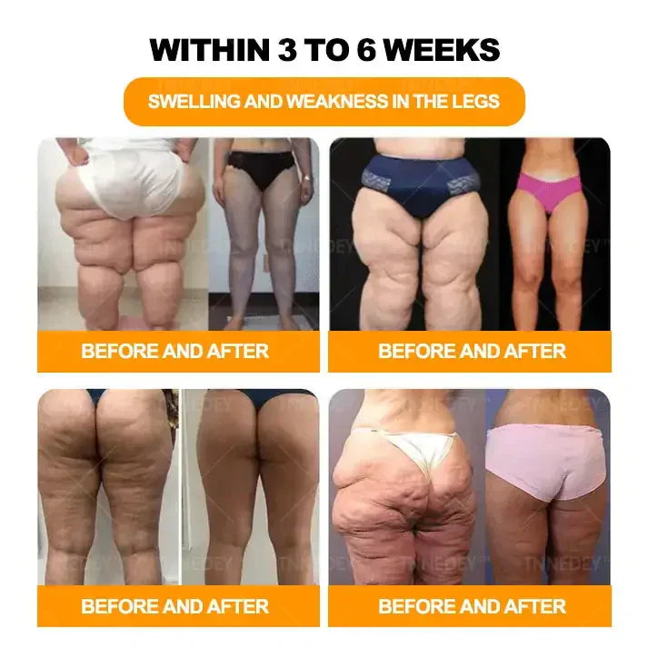 𝐓𝐧𝐧𝐞𝐝𝐞𝐲® 𝐁𝐞𝐞 𝐕𝐞𝐧𝐨𝐦 & 𝟑𝟎-𝐇𝐞𝐫𝐛 𝐃𝐞𝐭𝐨𝐱 𝐅𝐨𝐨𝐭 𝐒𝐨𝐚𝐤 𝐁𝐞𝐚𝐝𝐬 𝐟𝐨𝐫 𝐁𝐨𝐝𝐲 𝐒𝐜𝐮𝐥𝐩𝐭𝐢𝐧𝐠- Recommended by the Australian Orthopaedic Association (AOA)⚡🏆