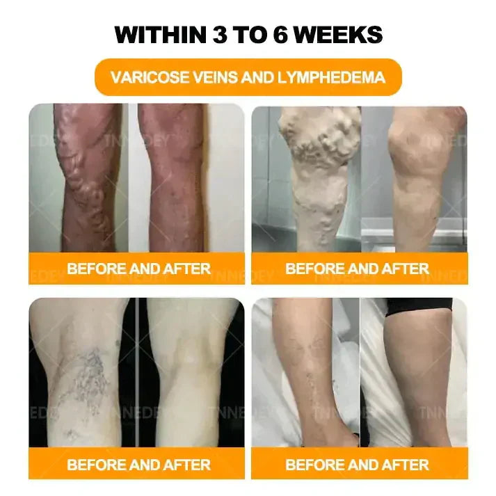 𝐓𝐧𝐧𝐞𝐝𝐞𝐲® 𝐁𝐞𝐞 𝐕𝐞𝐧𝐨𝐦 & 𝟑𝟎-𝐇𝐞𝐫𝐛 𝐃𝐞𝐭𝐨𝐱 𝐅𝐨𝐨𝐭 𝐒𝐨𝐚𝐤 𝐁𝐞𝐚𝐝𝐬 𝐟𝐨𝐫 𝐁𝐨𝐝𝐲 𝐒𝐜𝐮𝐥𝐩𝐭𝐢𝐧𝐠- Recommended by the Australian Orthopaedic Association (AOA)⚡🏆